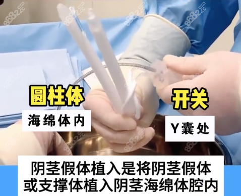 做陰莖假體三件套植入的價(jià)格為啥差這么多