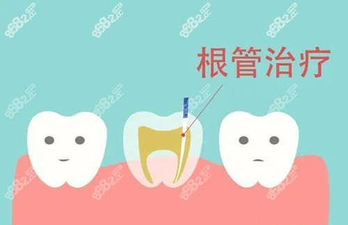 根管治疗亲身经历