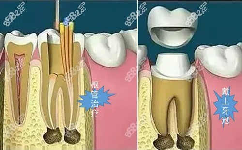 根管治疗过程