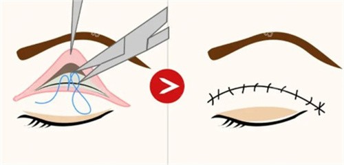 郑州双眼皮好的医生有哪些？5个双眼皮好看无维修医生