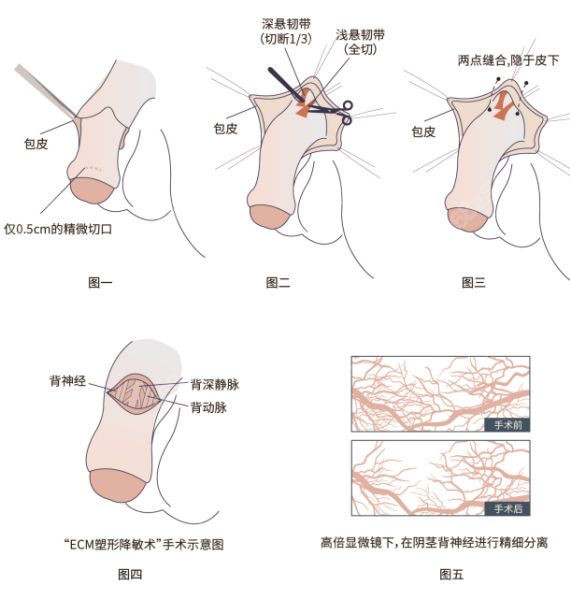 李世荣隐痕阴茎延长术图解
