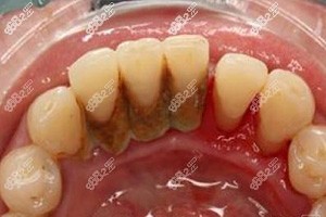 牙龈炎可以自愈吗？