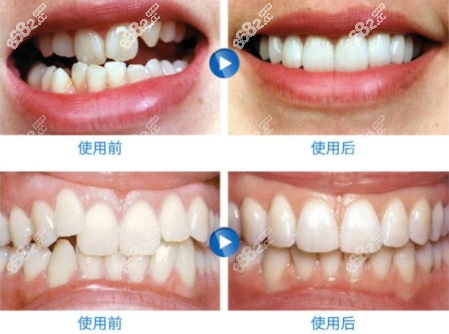 牙齒不齊錯(cuò)頜矯正效果圖