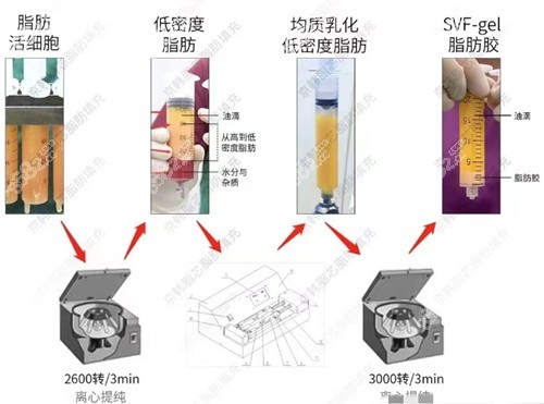 梁耀婵脂肪丰胸技术优势介绍