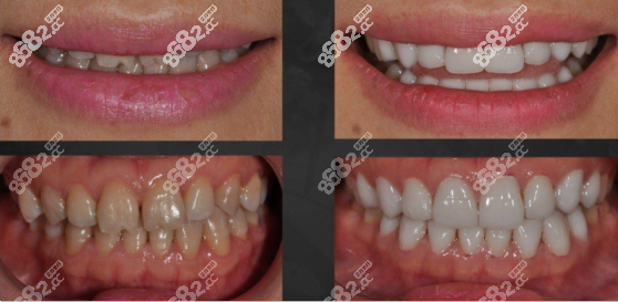 3D全瓷牙貼面效果圖