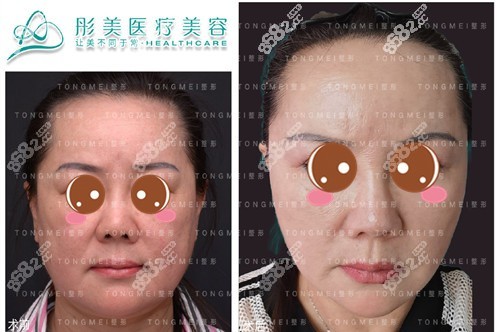 潘彦龙做面部提升效果好吗