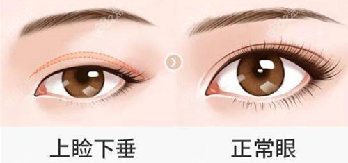 上睑下垂手术