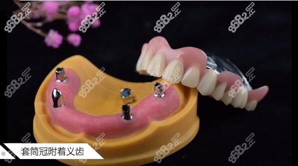 精密附着体义齿价格贵不贵呢