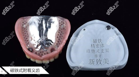 全口磁性附着体义齿多少钱
