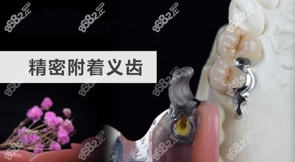 全新的精密附着体义齿价格表公布www.8682.cc