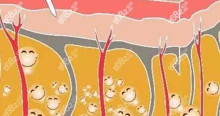 马梅生吸脂术示意图