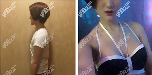 杭州连天美傲诺拉假体隆胸案例
