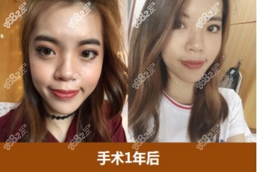 id医院眼部手术一年恢复照片