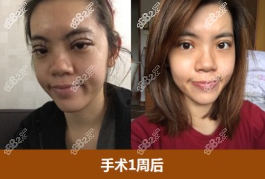 id医院眼睛术后一周照片
