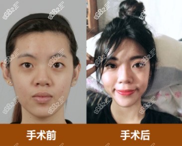 韩国id医院眼睛手术前后对比图