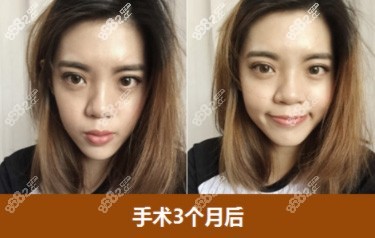 id医院眼睛手术3个月照片