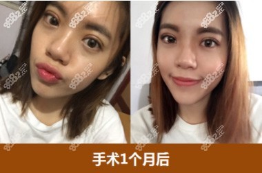 ID医院眼睛术后一个月照片