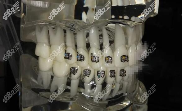 <!--<i data=20240705-sp></i>-->口腔牙齿矫正优惠价格便宜-8682