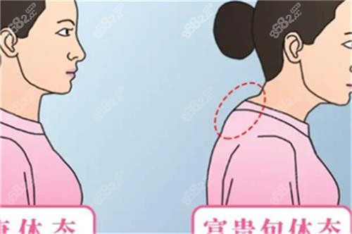全新李方伟富贵包收费明细：抽脂、切除价格一览