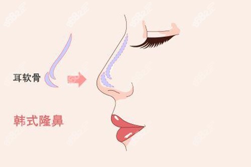 隆鼻手術(shù)示意圖