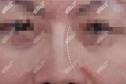 隆鼻手術(shù)失敗了怎么辦？