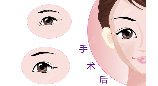 双眼皮整形www.8682.cc