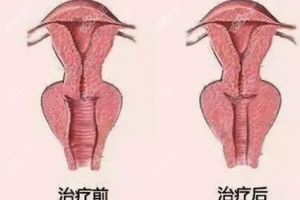 佳木斯打私密阴道紧缩针靠谱的医院