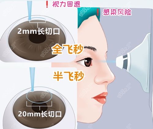 2025贵州省人民医院飞秒近视价格表:全飞秒激光2.08w+|蔡司4.0