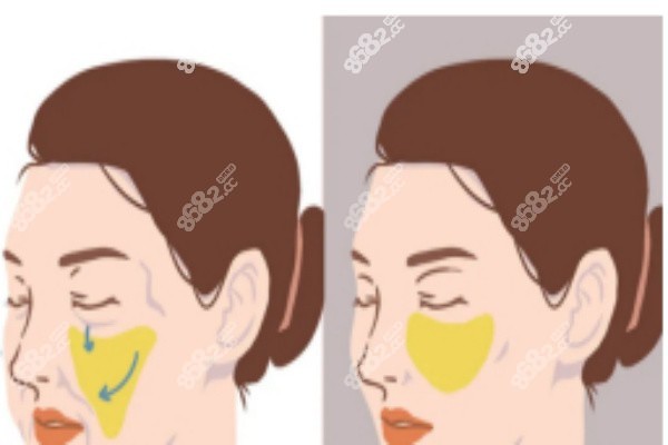 自体脂肪丰颜术 自体脂肪丰颜术