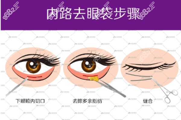 内切祛眼袋 内切祛眼袋