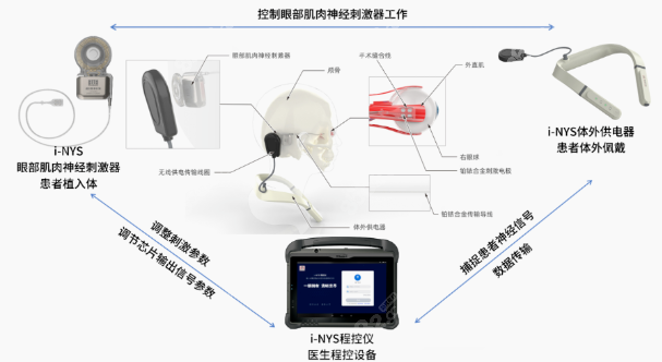 王乐今i-NYS植入治疗眼球震颤好吗