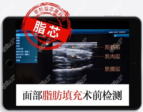 面部脂肪填充前的检测