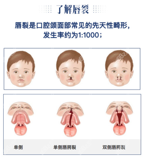 唇裂手術(shù)