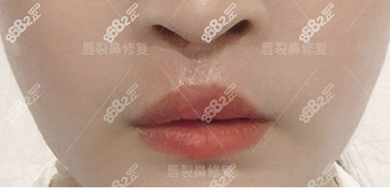 陳國(guó)鼎醫(yī)生做唇裂手術(shù)的真人圖片