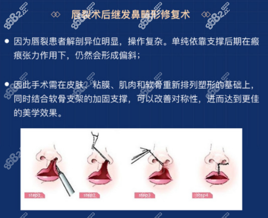 唇裂手術(shù)引發(fā)的鼻畸形治療