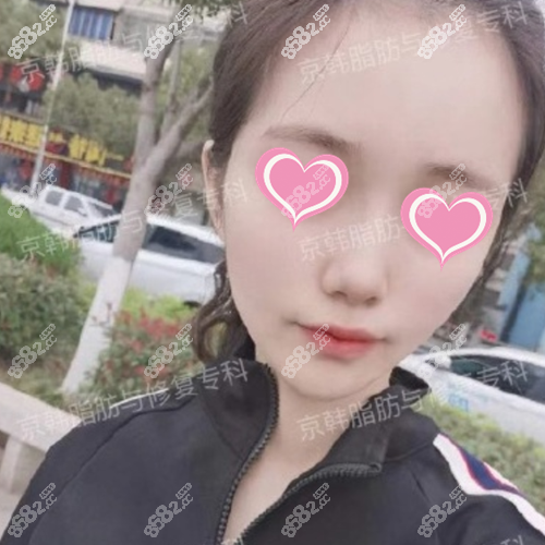 乔爱军脂肪填充后的效果