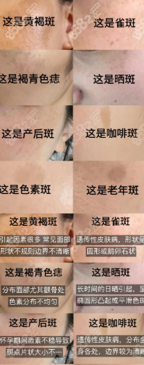 光子嫩膚1-15天變化圖
