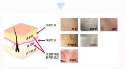 光子嫩肤