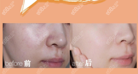 光子嫩肤