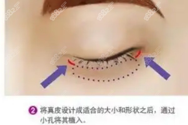 吕方中医生修复双眼皮的好口碑是咋来的