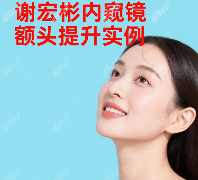 谢宏彬内窥镜额头提升实例:1cm微创切口去抬头纹+提升眼尾!