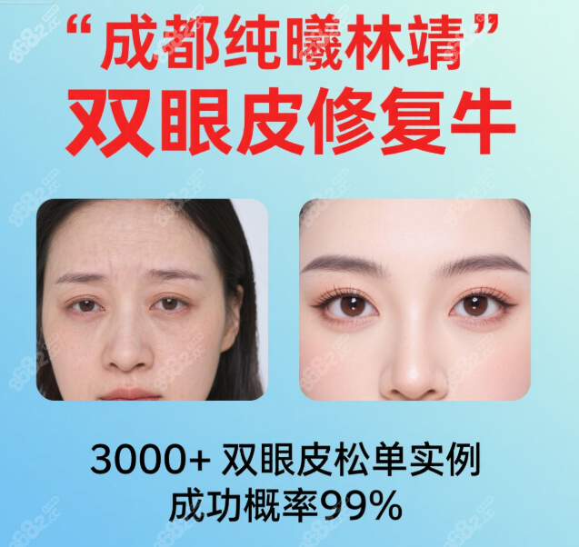 成都纯曦林靖双眼皮修复牛:3000+双眼皮松单实例成功概率99%