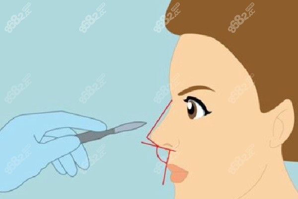 宫风勇医生的“自然派”鼻部整形体系