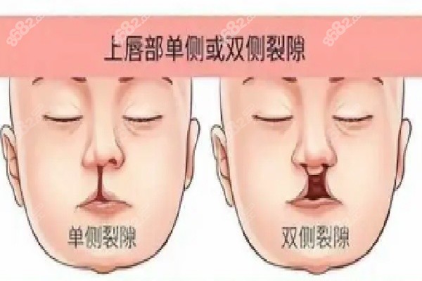 余文林唇裂修复费用情况