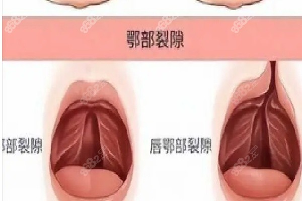 余文林单侧唇裂修复的神奇成效