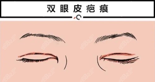 双眼皮疤痕修复动画图
