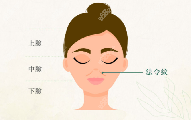玻尿酸填充法令纹