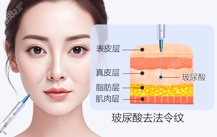 玻尿酸填充法令纹