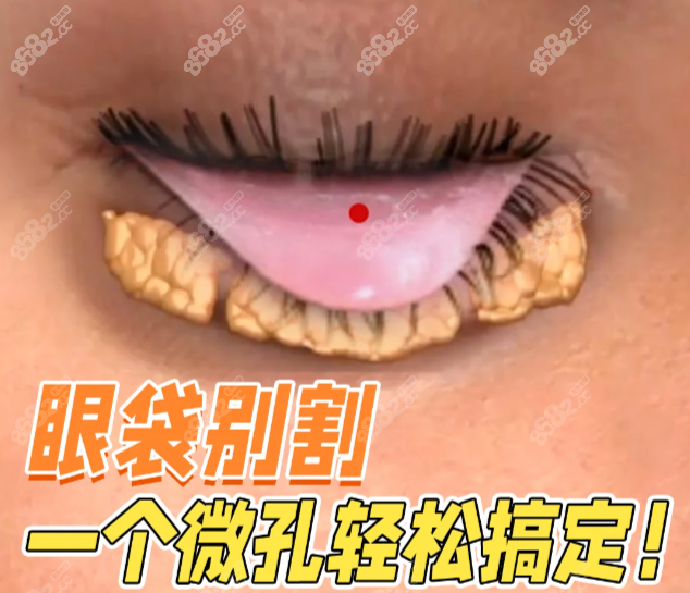 成都健丽医美不开刀祛眼袋真人实探