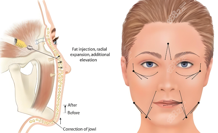 內(nèi)窺鏡拉皮"黑科技"震驚同行